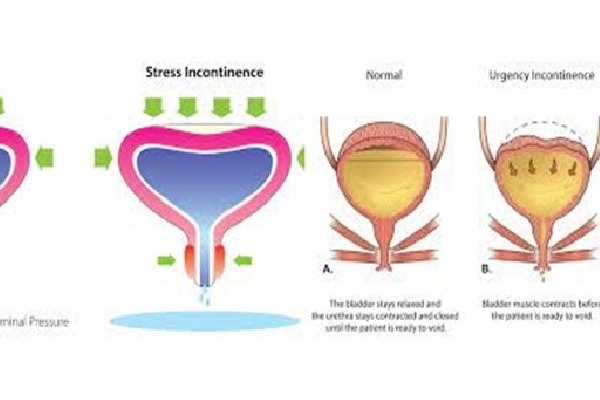 Urinary Incontinence