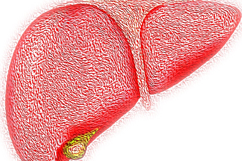 Obesity, diabetes driving hidden pandemic of fatty liver disease