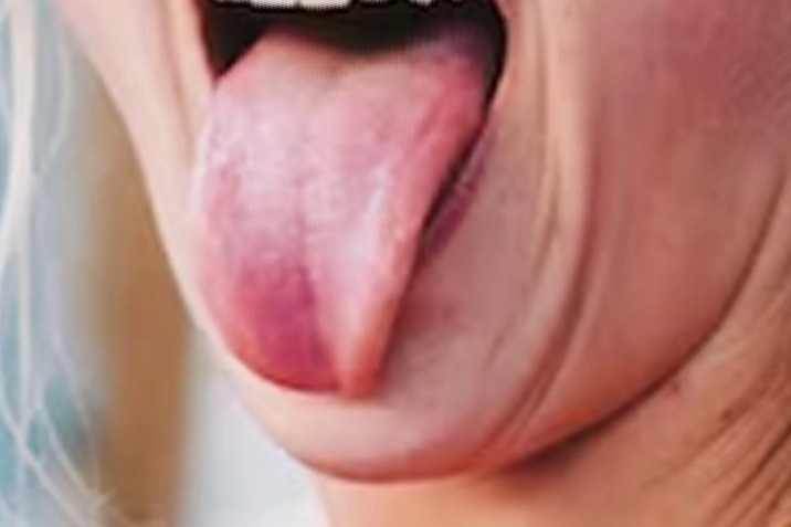 Tongue reconstructed with microvascular surgery in UP hospital