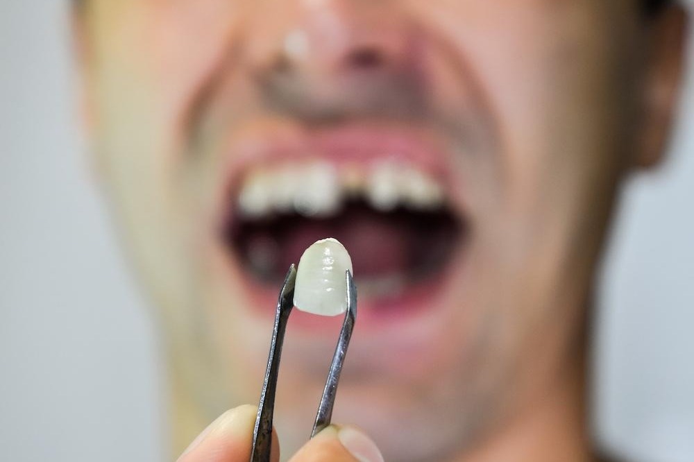 New technique to replace lost teeth: Experts