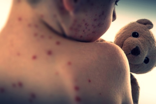 Measles cases rising alarmingly across Europe: WHO