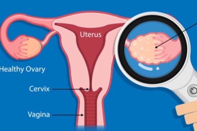 New AI-based test to detect ovarian cancer early with 93% accuracy