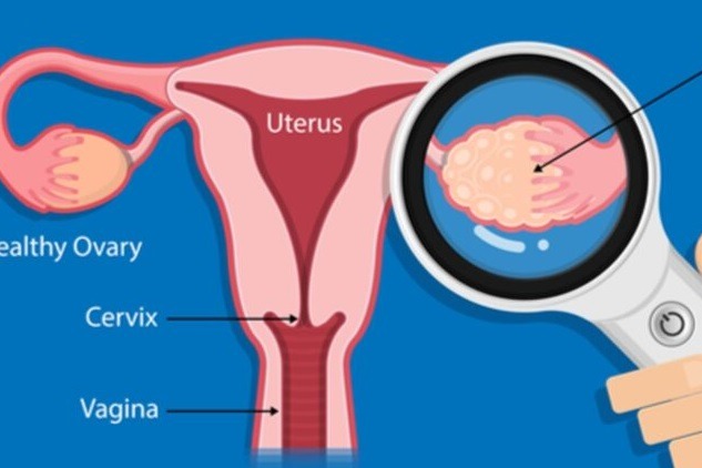 Women with PCOS more likely to have memory, thinking issues in middle age: Study