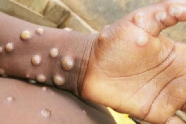 Monkeypox case detected in South Africa