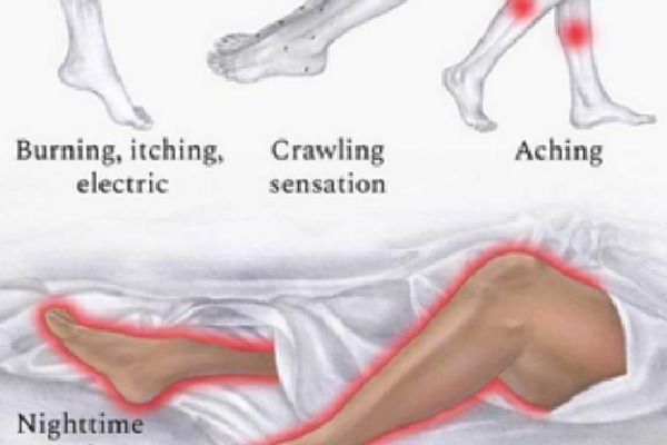 Scientists find treatment for restless leg syndrome