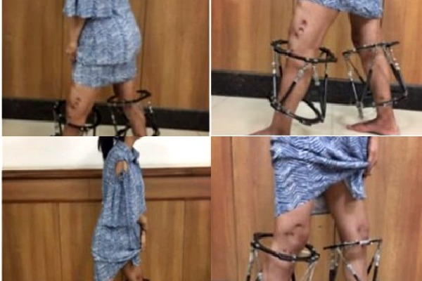 New AI-assisted technique makes teenage girl's crooked legs straight