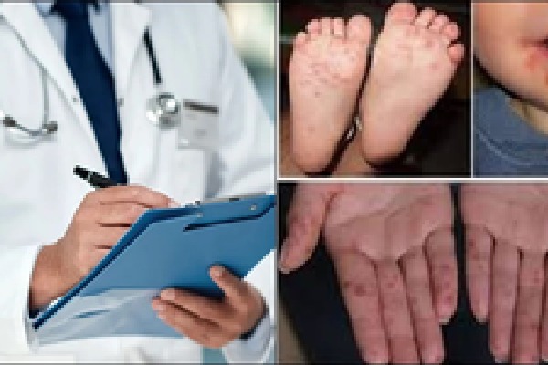 Delhi doctors see surge in hand, foot & mouth disease in young children