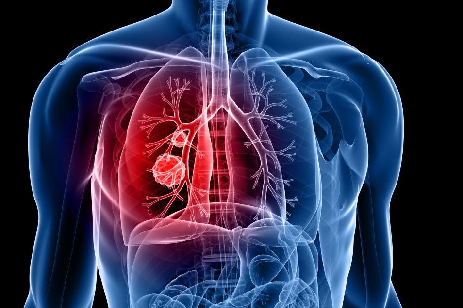 Lung cancer is most common cancer to spread to brain: Experts