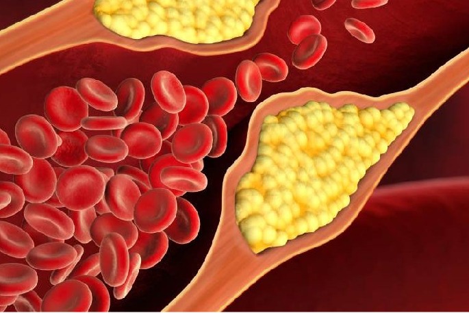 Indian researchers find a new, cheaper route to manage cholesterol