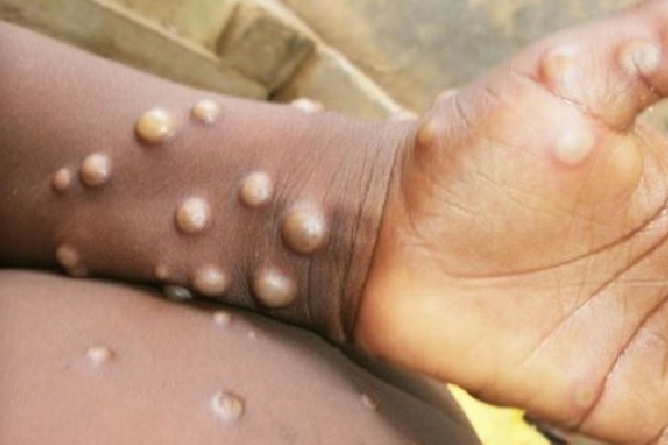 China tightens precautions at ports as global mpox cases increase