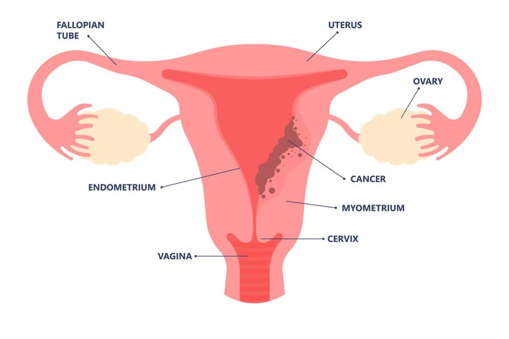 Why gynaecological cancers are rising among young Indian women