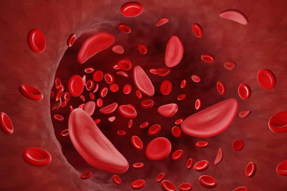 ICMR, Zydus tie up for clinical trial to combat sickle cell disease