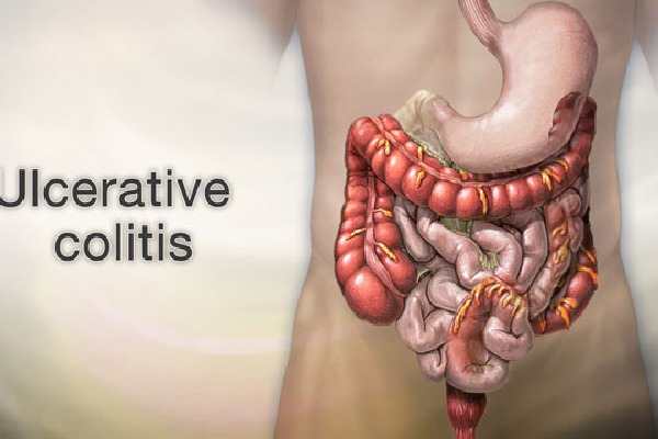 Scientists link colon cancer risk to specific gene in ulcerative colitis