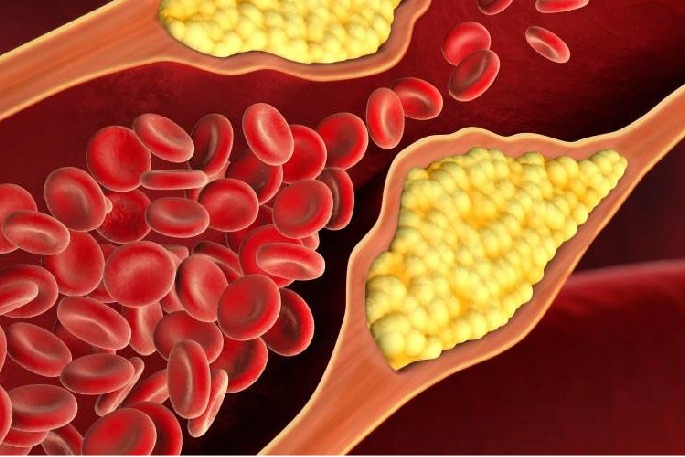 Covid infection spiked high cholesterol risk by 30pc: Study