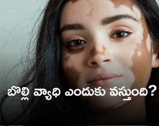 What is vitiligo The skin condition Malayalam actress Mamta is diagnosed with