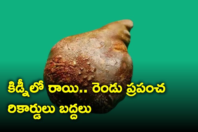 Sri Lankan Doctors Removed World Largest Kidney Stone