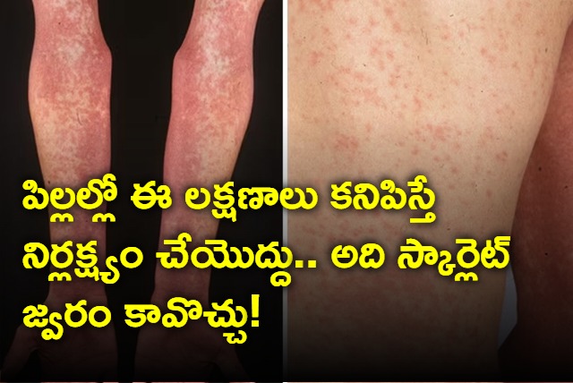 Hyderabad Children Suffers From Scarlet Fever