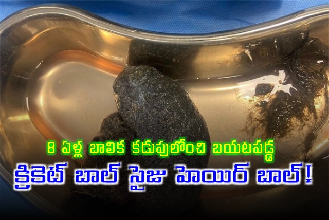 Bengaluru Doctors Remove Cricket Ball sized Hairball from 8 Year old Girl Stomach